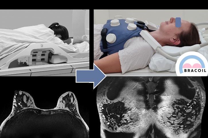 Two MRI images of a breast made with the BraCoil hardware, the hardware can be seen on one photo